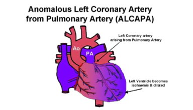 Bất thường động mạch vành trái từ động mạch phổi
