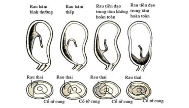 Thai bám sẹo mổ lấy thai, nhau tiền đạo, nhau cài răng lược