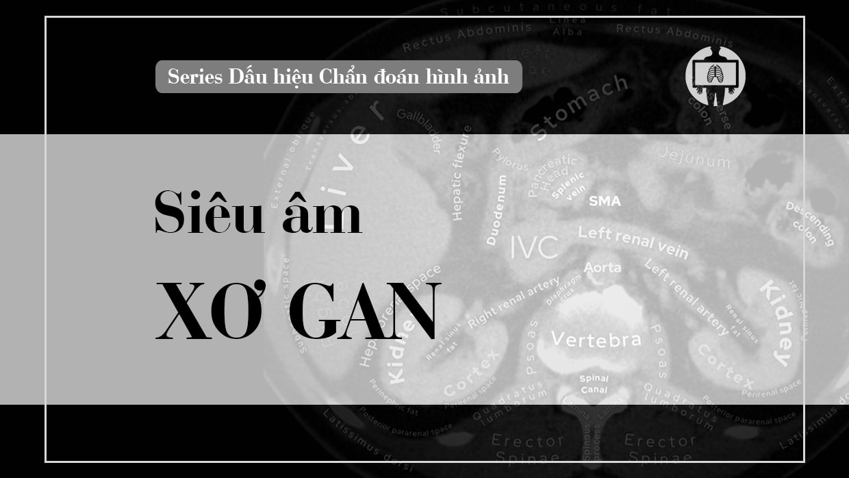 sieu am xo gan