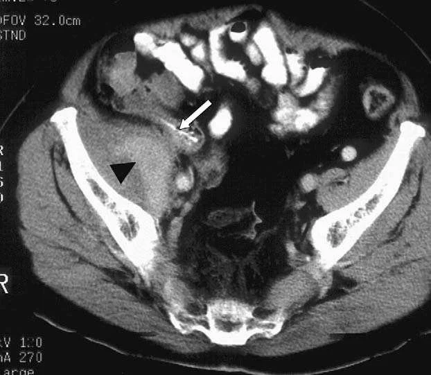 Hình ảnh ruột thừa trên CT (The appendix on CT) | Hình ảnh Y khoa | Chẩn đoán hình ảnh | Siêu âm, XQ, CT, MRI