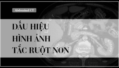 Cac dau hieu hinh anh tac ruot non