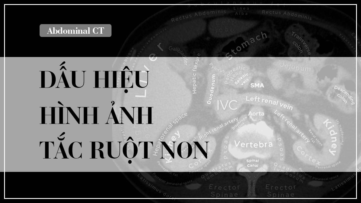 Cac dau hieu hinh anh tac ruot non