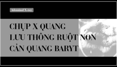 Chup x quang luu thong ruot non can quang