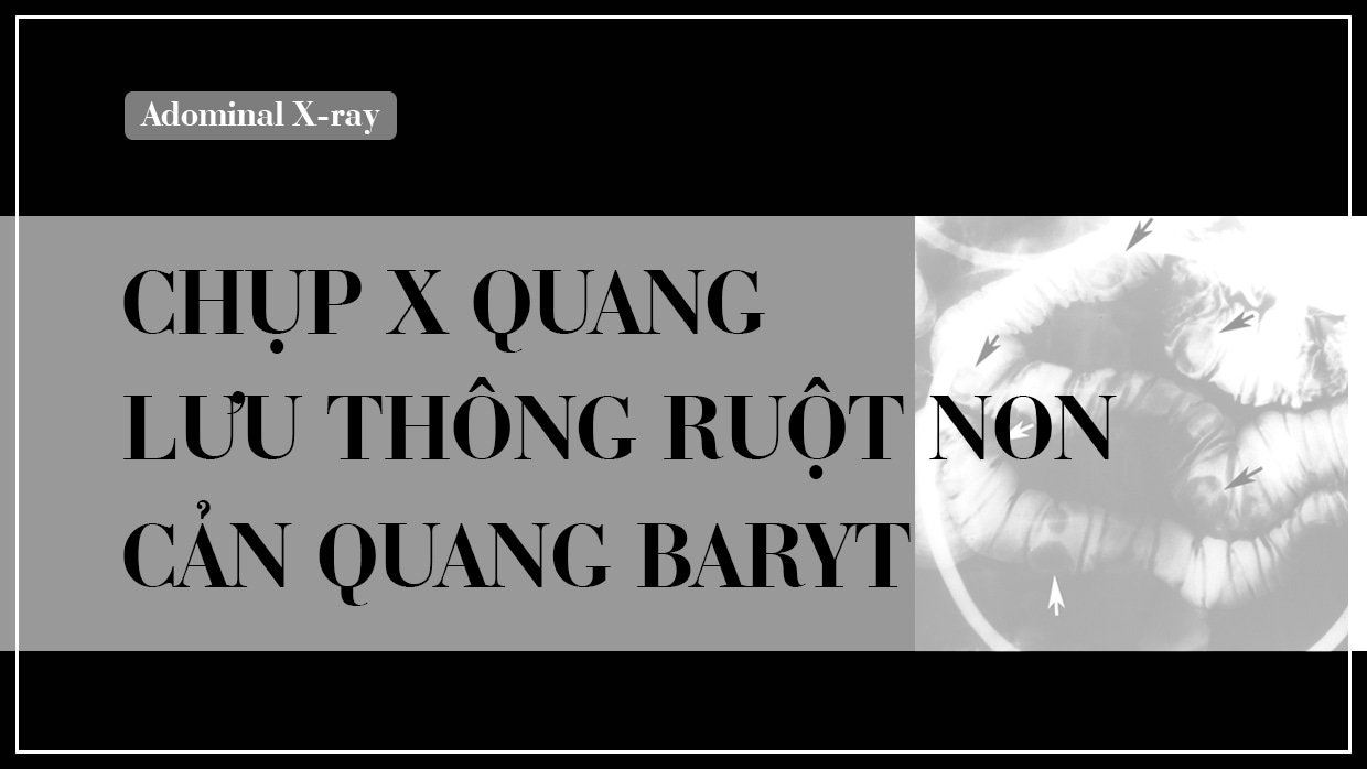 Chup x quang luu thong ruot non can quang