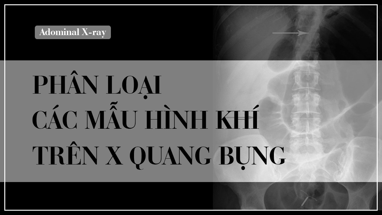 Phan loai cac mau hinh khi tren X quang bung