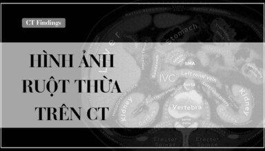 CT ruot thua