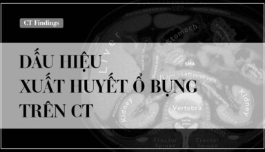 Dau hieu CT xuat huyet o bung