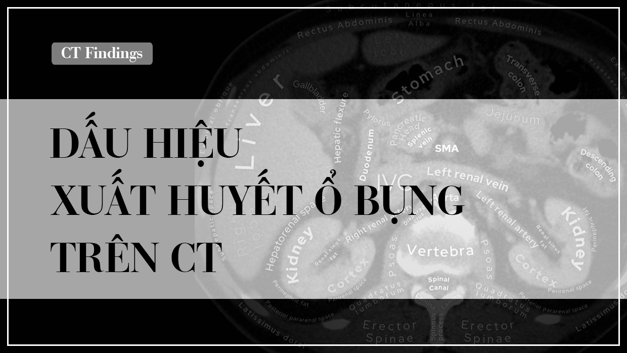 Dau hieu CT xuat huyet o bung