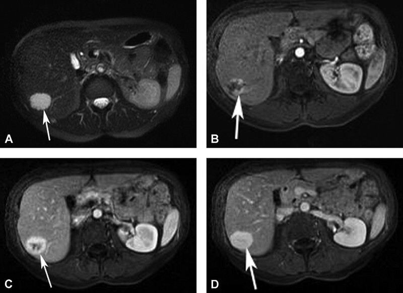 Cac Ton Thuong Gan Khu Tru Giau Mach Mau - Hinh 03
