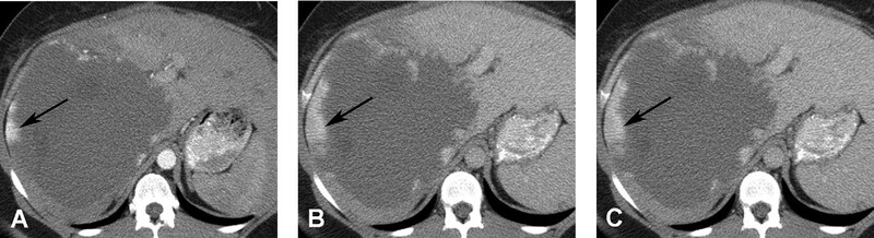 Cac Ton Thuong Gan Khu Tru Giau Mach Mau - Hinh 04