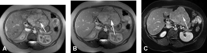 Cac Ton Thuong Gan Khu Tru Giau Mach Mau - Hinh 07