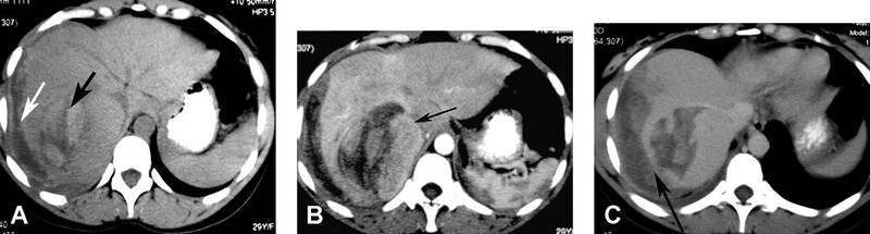 Cac Ton Thuong Gan Khu Tru Giau Mach Mau - Hinh 08