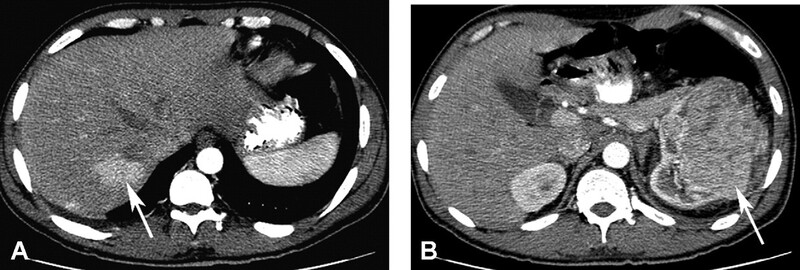 Cac Ton Thuong Gan Khu Tru Giau Mach Mau - Hinh 15