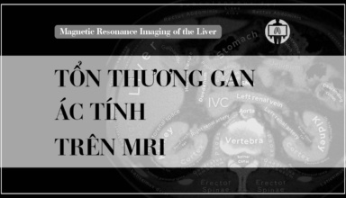 Mri Gan Ton Thuong Ac Tinh