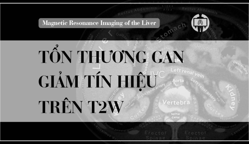 Mri Gan Ton Thuong Giam Tin Hieu Tren T2w