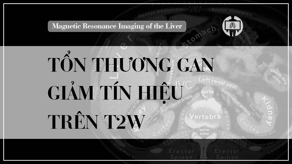 Mri Gan Ton Thuong Giam Tin Hieu Tren T2w