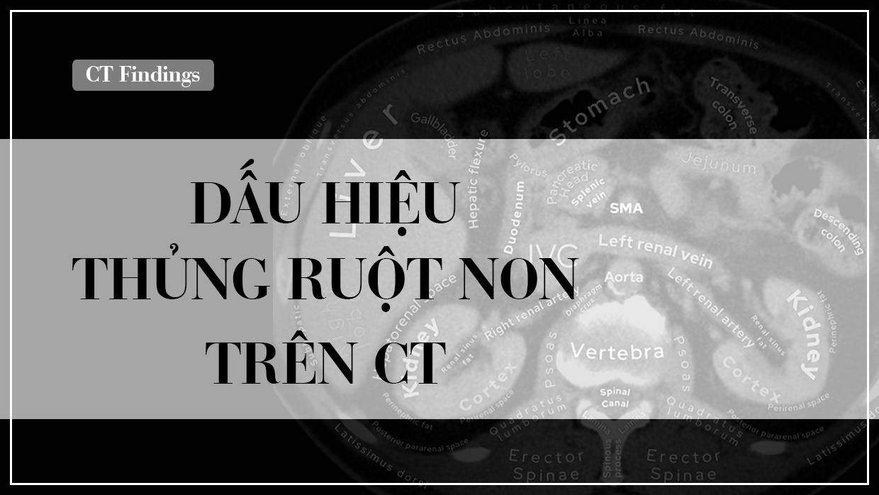 CT thung ruot non