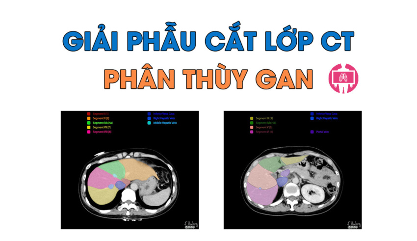 Giai Phau Cat Lop Phan Thuy Gan Tren Ct