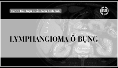 lymphangioma o bung