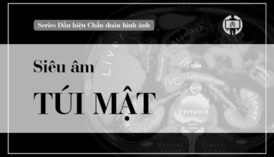 sieu am tui mat
