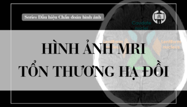 Hinh anh MRI ton thuong vung ha doi