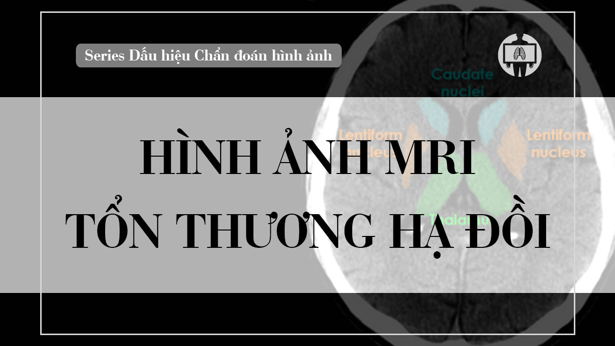 Hinh anh MRI ton thuong vung ha doi