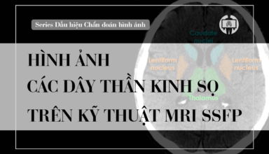 Hinh anh cac day than kinh so tren mri ssfp