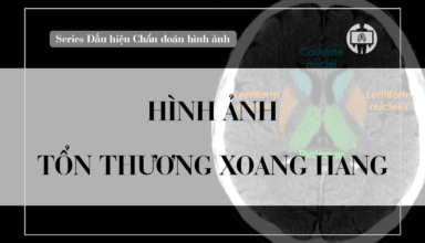 Hinh anh ton thuong xoang hang
