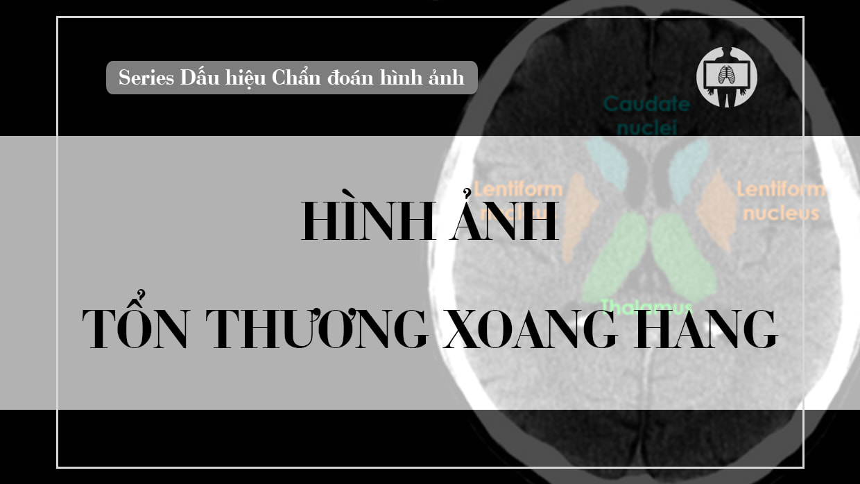 Hinh anh ton thuong xoang hang