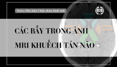 Cac bay trong anh cong huong tu khuech tan nao