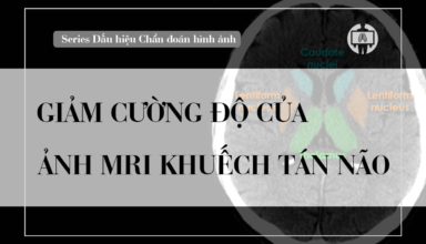 Giam cuong do cua anh MRI khuech tan nao