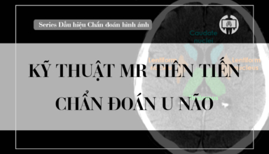 Ky thuat MR tien tien chan doan u nao