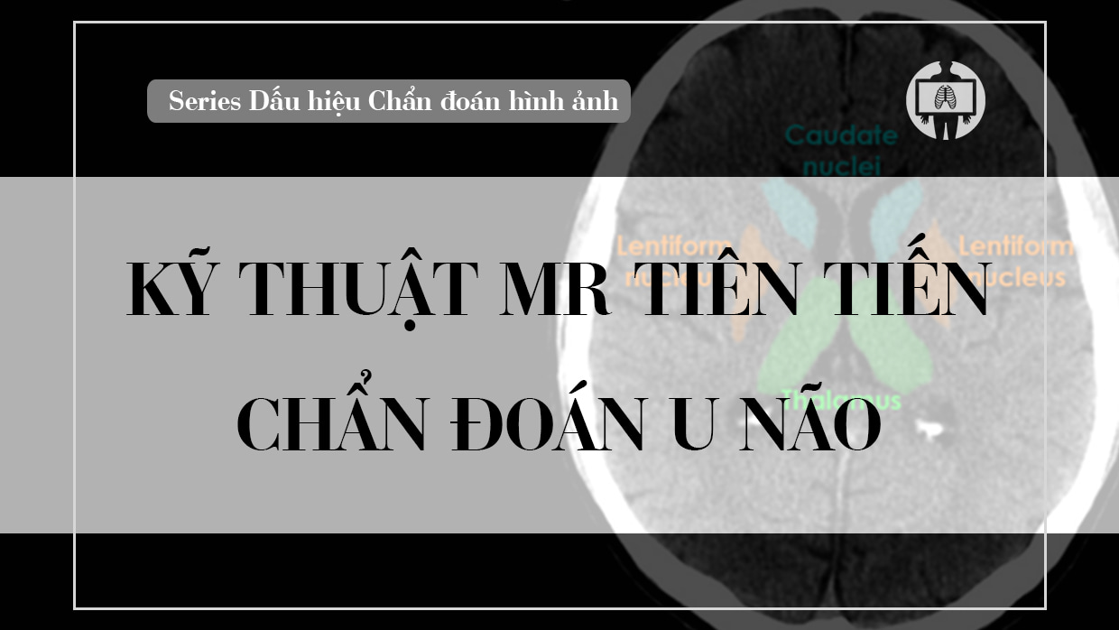 Ky thuat MR tien tien chan doan u nao
