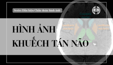 hinh anh khuech tan nao