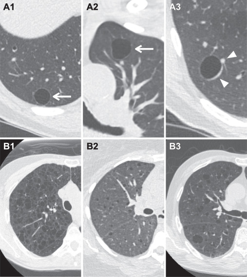 ACR Lung-RADS v2022 Danh gia phan loai va khuyen cao quan ly Hinh 01