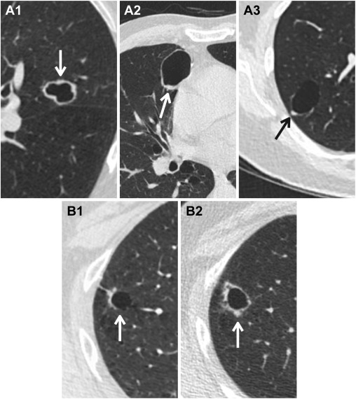 ACR Lung-RADS v2022 Danh gia phan loai va khuyen cao quan ly Hinh 02