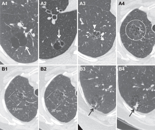 ACR Lung-RADS v2022 Danh gia phan loai va khuyen cao quan ly Hinh 03