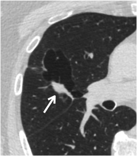ACR Lung-RADS v2022 Danh gia phan loai va khuyen cao quan ly Hinh 04