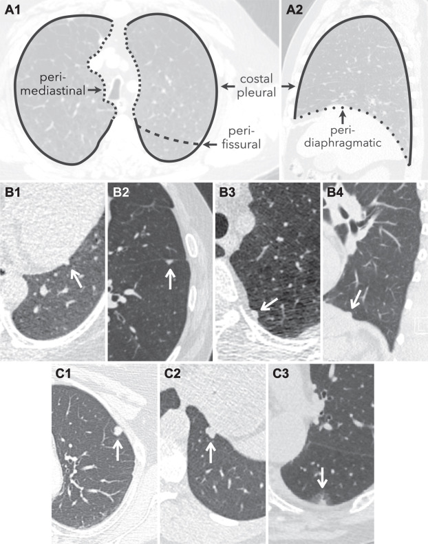 ACR Lung-RADS v2022 Danh gia phan loai va khuyen cao quan ly Hinh 05