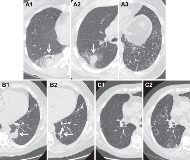 ACR Lung-RADS v2022 Danh gia phan loai va khuyen cao quan ly Hinh 06
