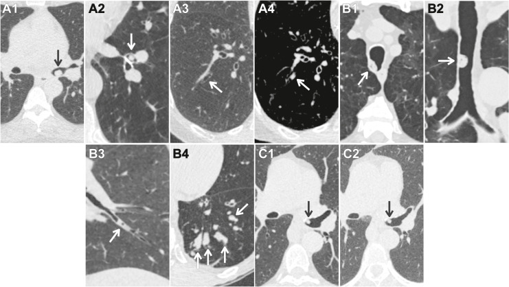ACR Lung-RADS v2022 Danh gia phan loai va khuyen cao quan ly Hinh 07