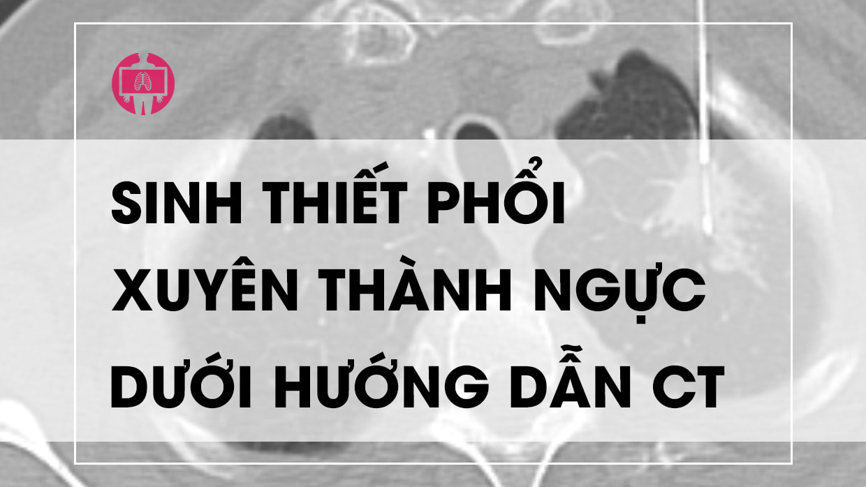 Ky thuat sinh thiet phoi xuyen thanh nguc duoi huong dan CT