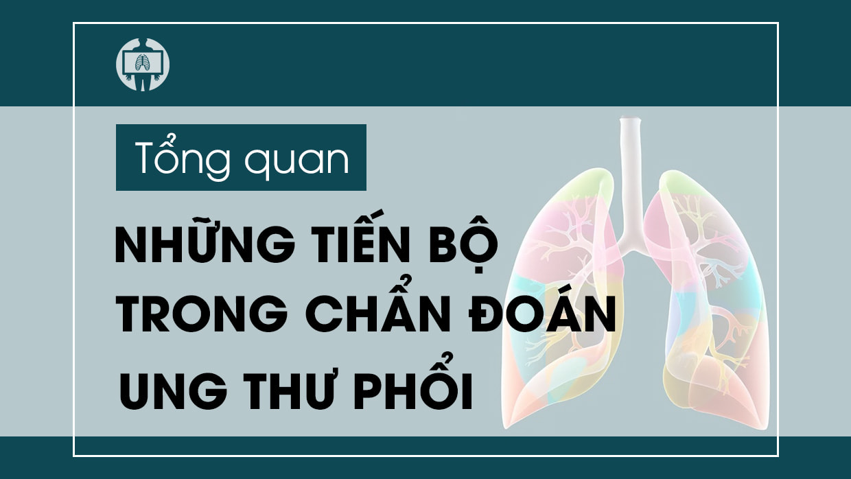 Nhung tien bo trong chan doan ung thu phoi