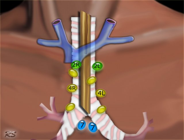 Ban do hach trung that - hinh 18_conventional mediastinoscopy