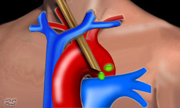 Ban do hach trung that - hinh 19_extended mediastinoscopy
